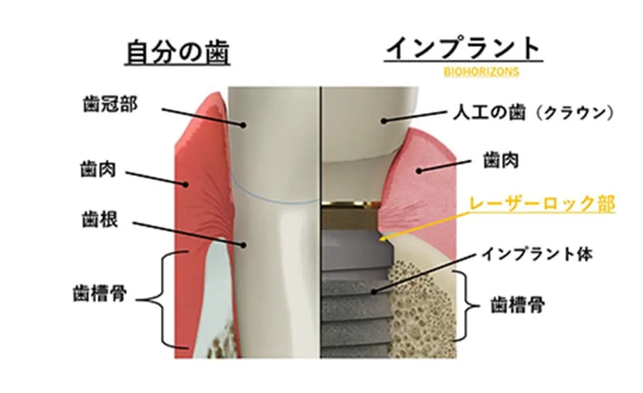 BioHorizonsインプラントの特長