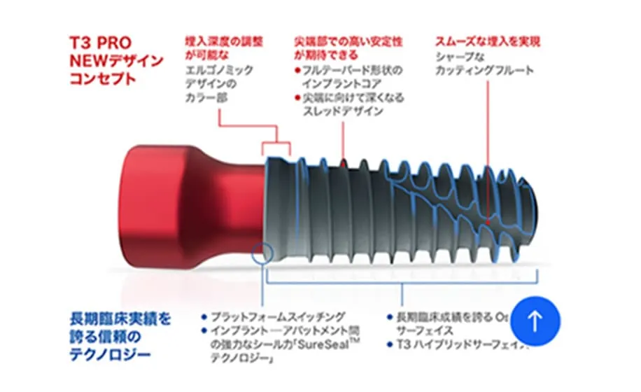 3iインプラントの特長